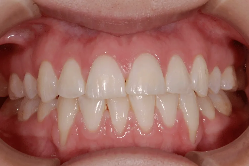 歯肉退縮治療例