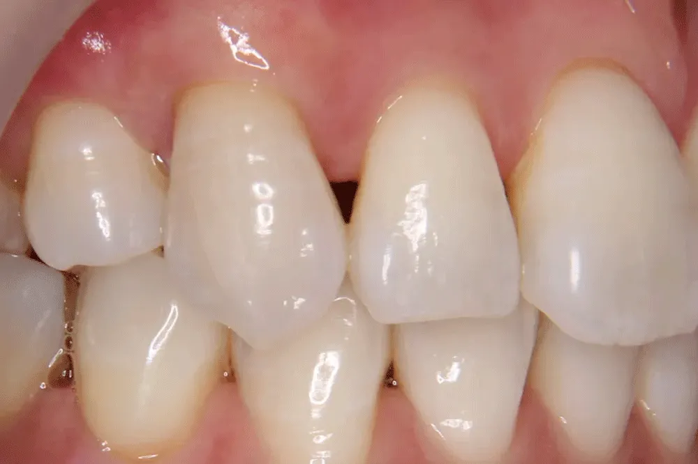 歯肉退縮治療例