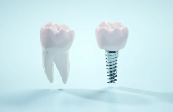 健康な歯の状態にもっとも近づく治療