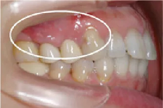 歯周組織再生治療術後1ヶ月