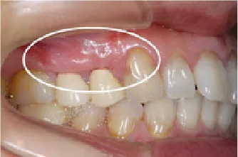 歯周組織再生治療術後3ヶ月