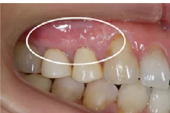 歯周組織再生治療術後5ヶ月