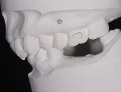 歯が無いことで骨が下がった下顎にインプラントを埋入したケース