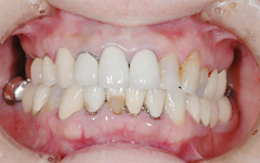 審美歯科治療例（フルオールセラミック）
