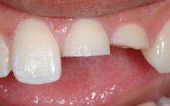 審美歯科治療例（歯牙破折）