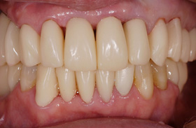 歯周組織再生治療例