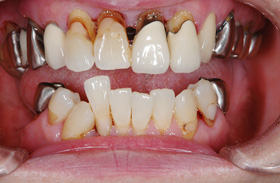 歯周組織再生治療例