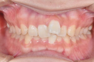インビザライン（マウスピース矯正）出っ歯矯正治療例